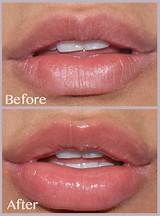 Achieve Plumper Lips with Expert Lip Injections in Santa Barbara