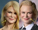 The Truth About Botox: Nicole Kidman's Experience