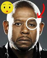 Unveiling Forest Whitaker's Eye Problem: Unraveling the Mystery