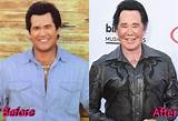 Wayne Newton Plastic Surgery, Know Everything About Wayne Newton.